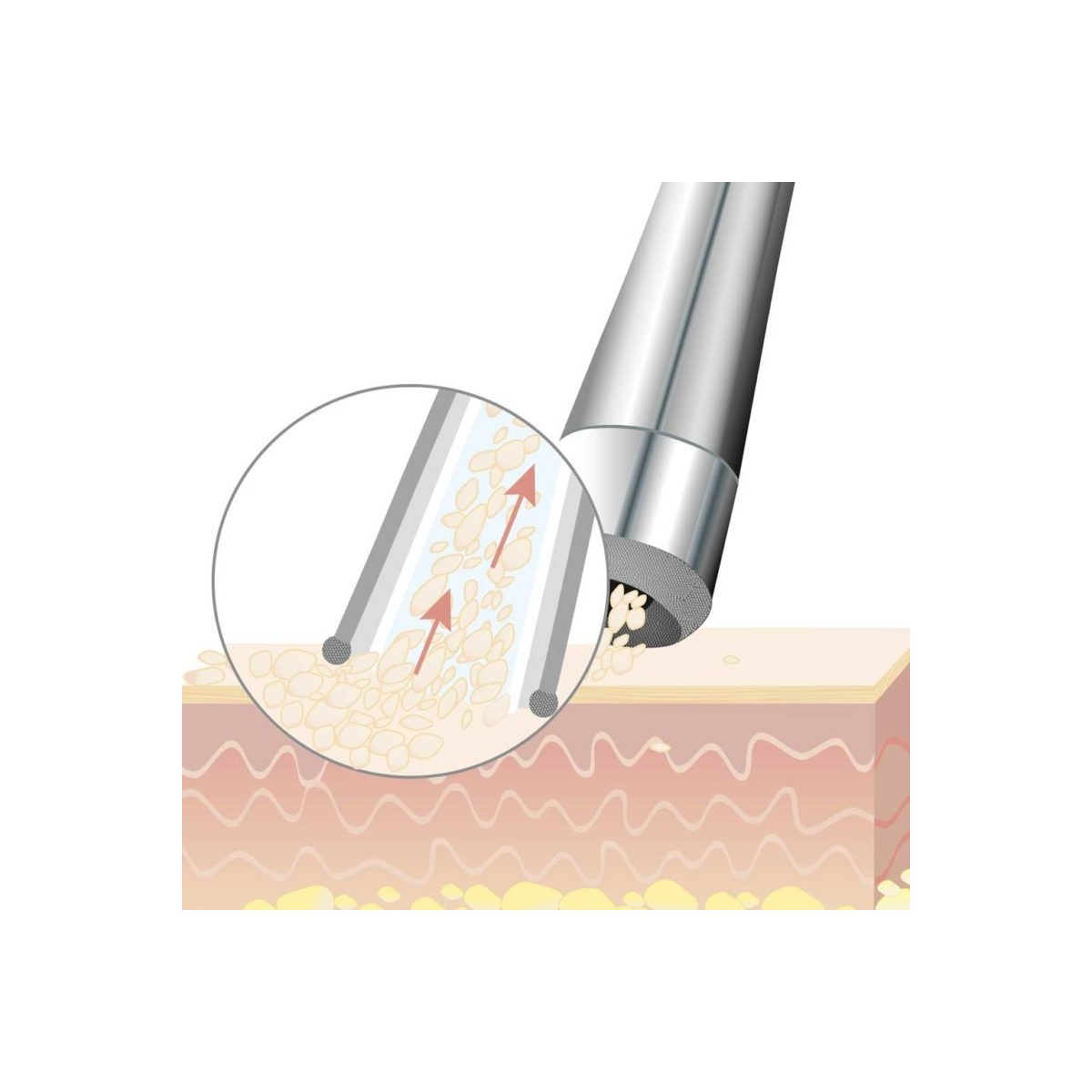 Beurer - FC 100 Pureo Derma Peel Microdermabrasie — foto 6